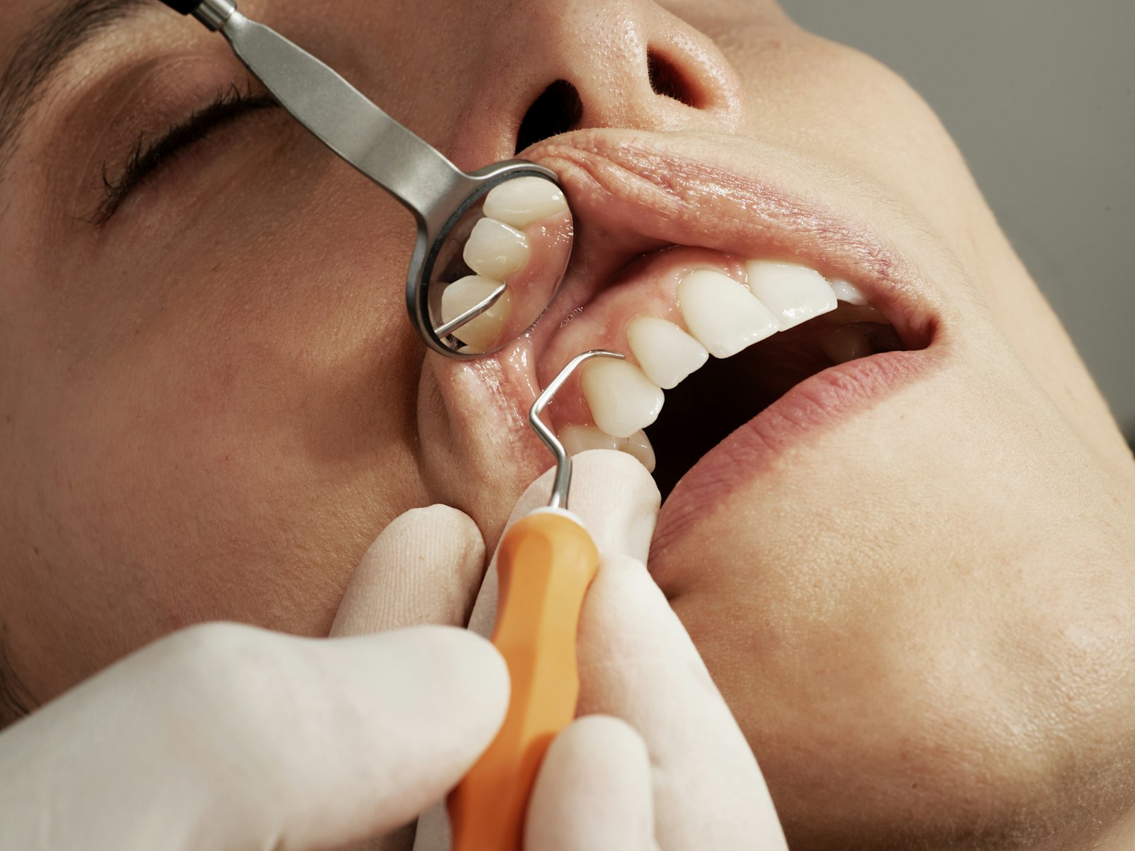 Limpieza dental profesional